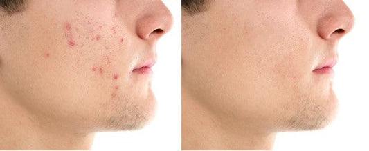 Acne Causes, Prevention, and How Our Brand Can Help